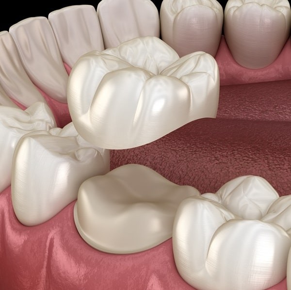 Dental Crown Image 1