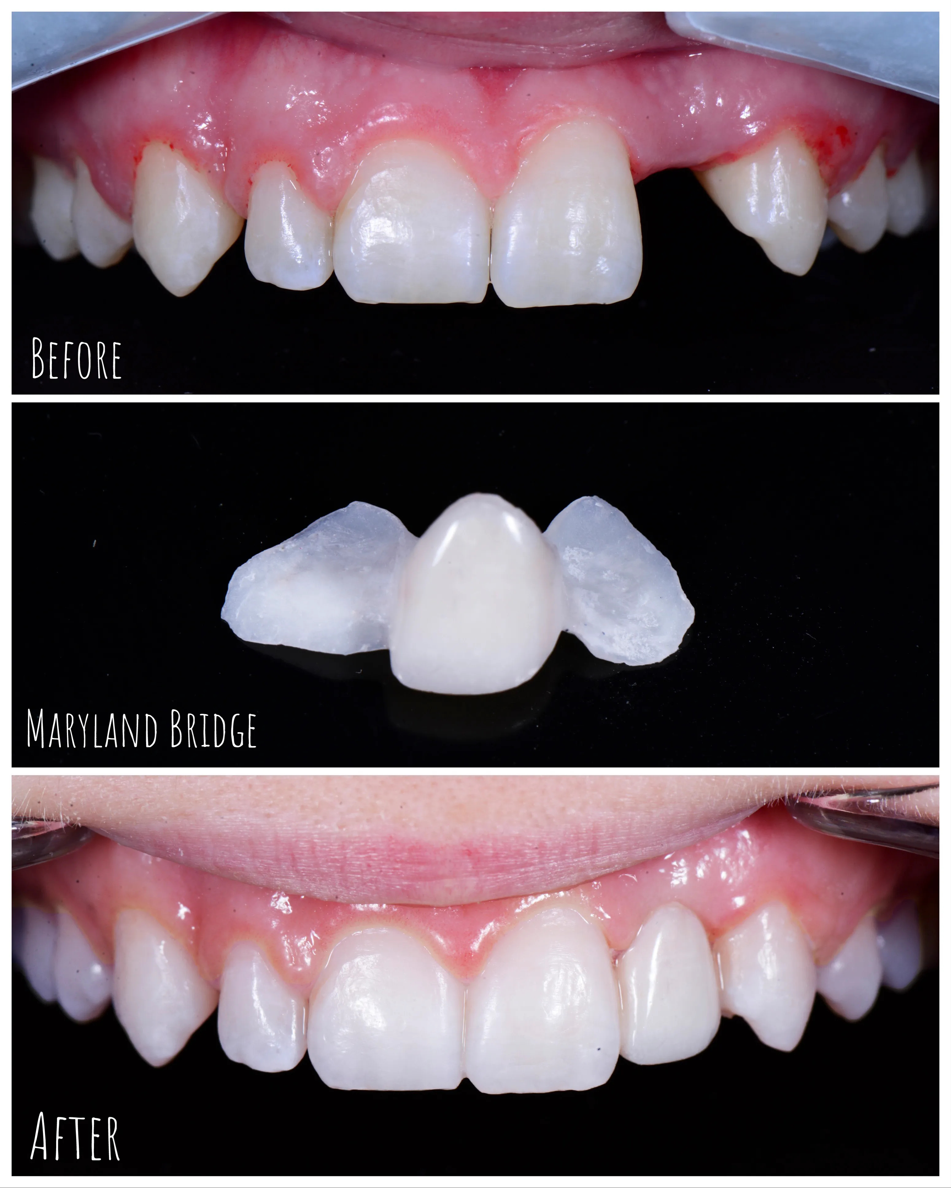 Dental Bridge Example