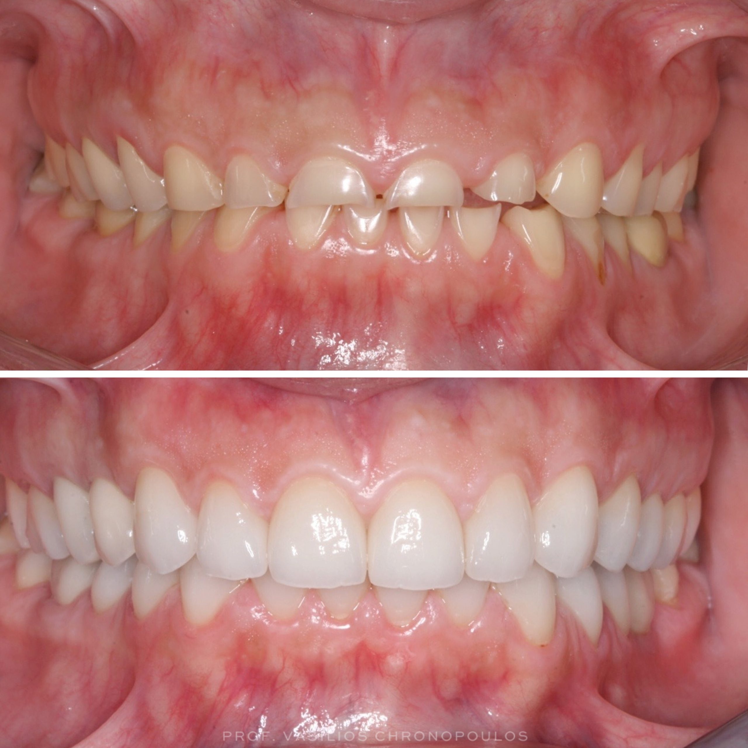 Bite Disorder Treatment at Twinkle Sanghavi Dental Care