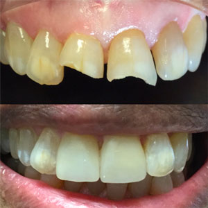 Dentist Performing Tooth Bonding
