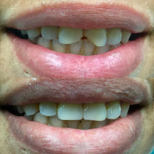 Close-Up Of Dental Tooth Bonding