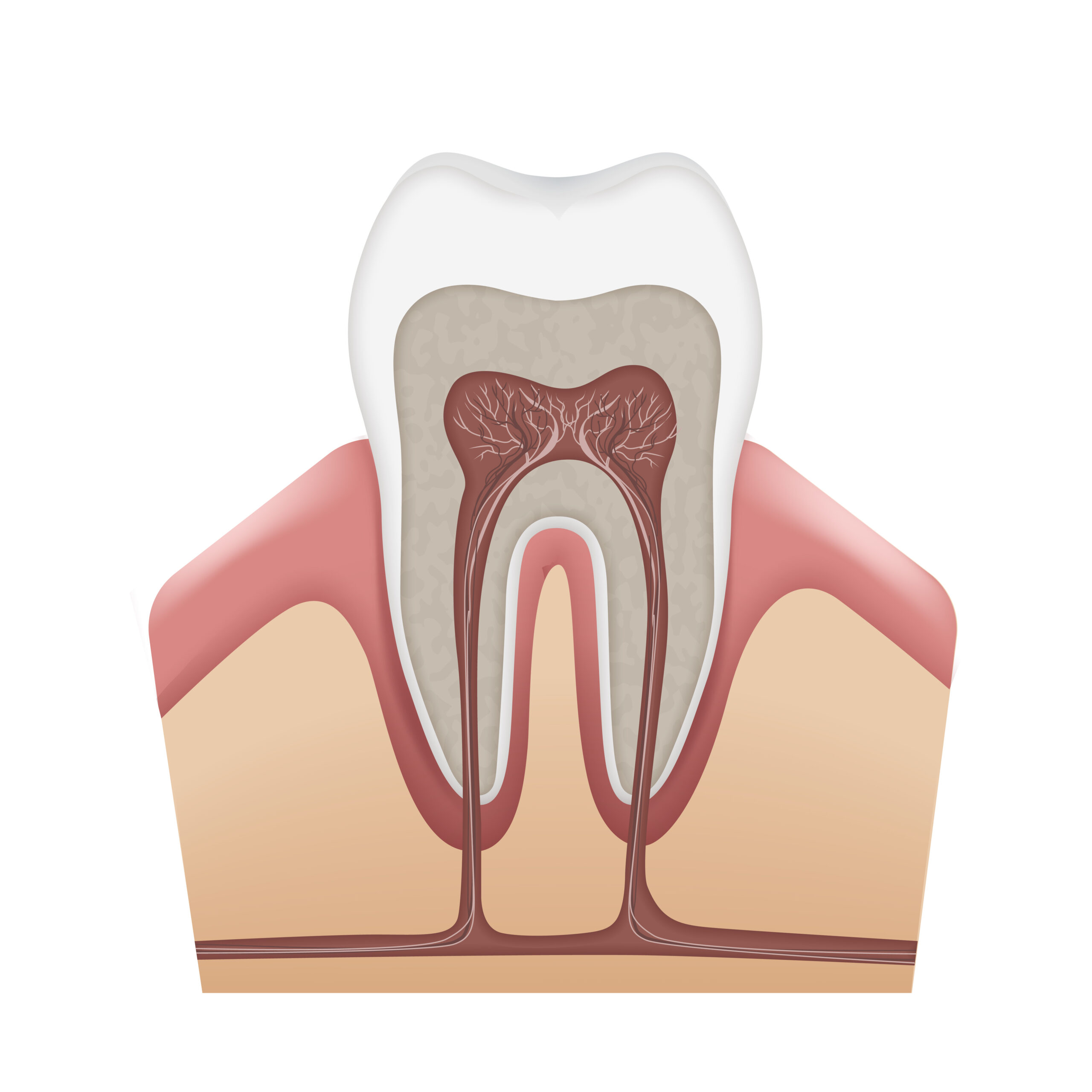 Root Canal